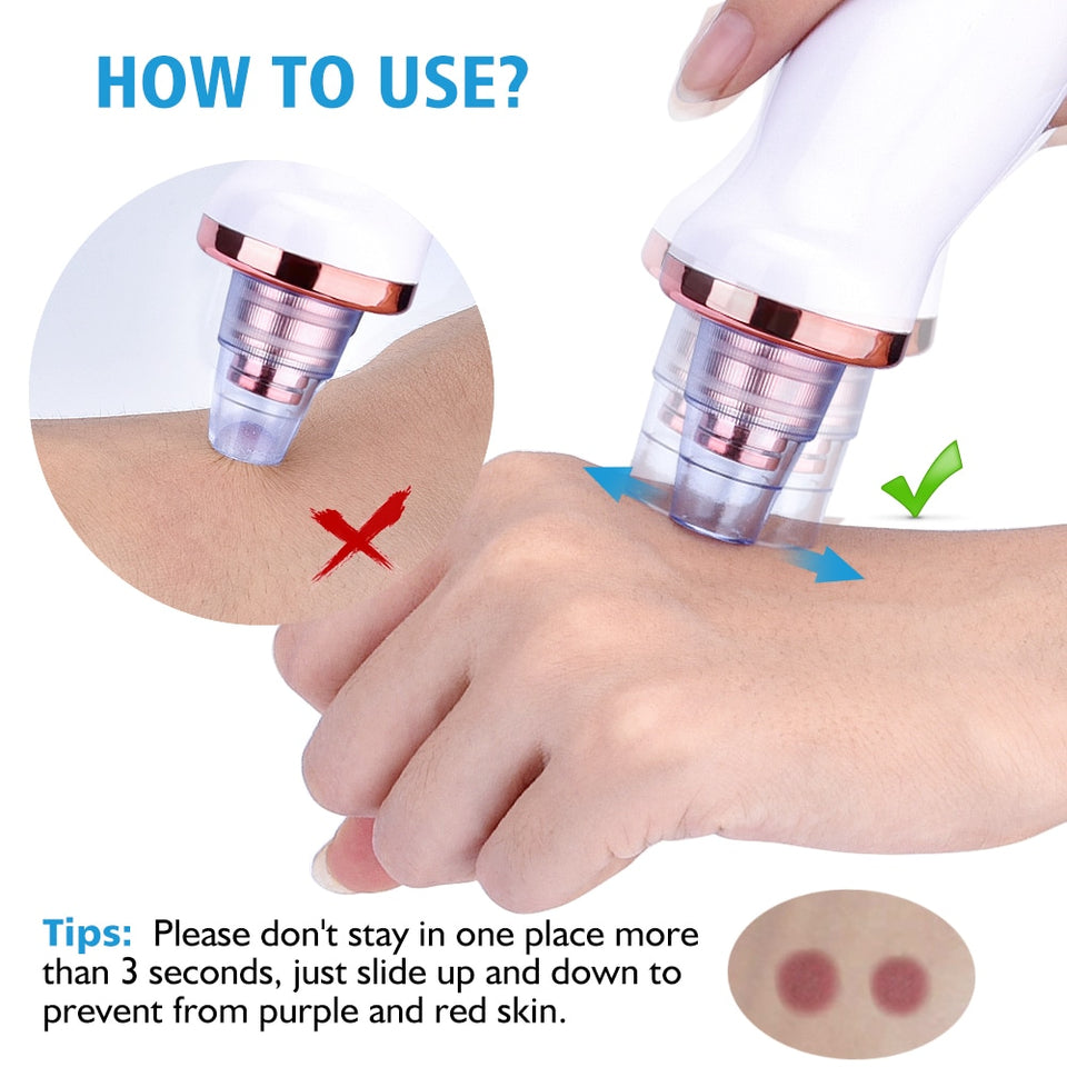 BLACKHEAD REMOVER